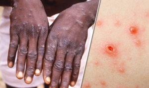 How concerned should we be about monkeypox?